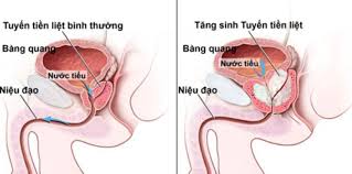 Vôi hóa (sỏi) tiền liệt tuyến - Hình ảnh minh họa